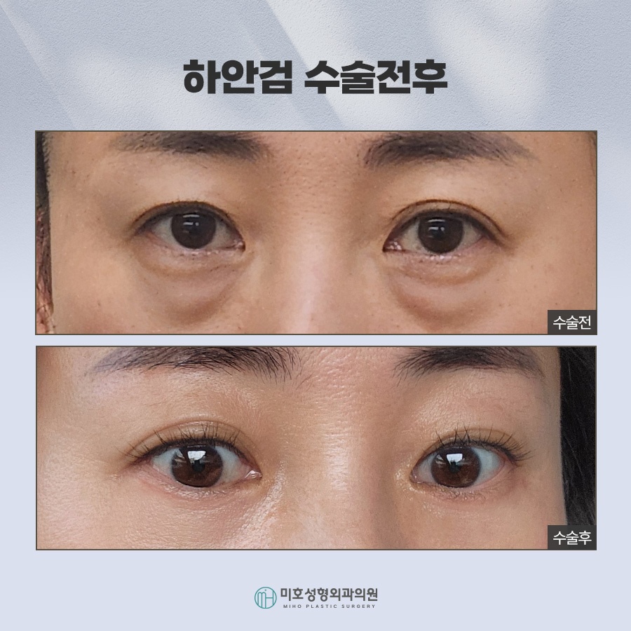 An In-Depth Analysis of Upper and Lower Blepharoplasty image 8