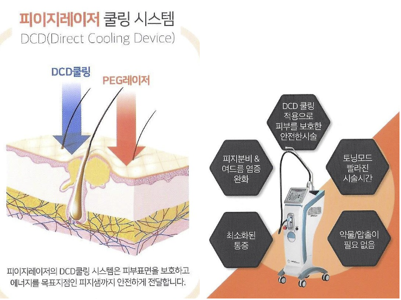 여드름&middot;피지 조절에 최적화된 레이저, 네오빔(NEO Beam) 관련 이미지 3