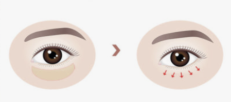 Lower Blepharoplasty, Under-Eye Fat Repositioning image 1