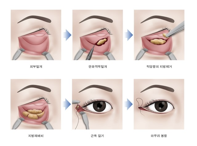 Lower Blepharoplasty, Under-Eye Fat Repositioning image 2