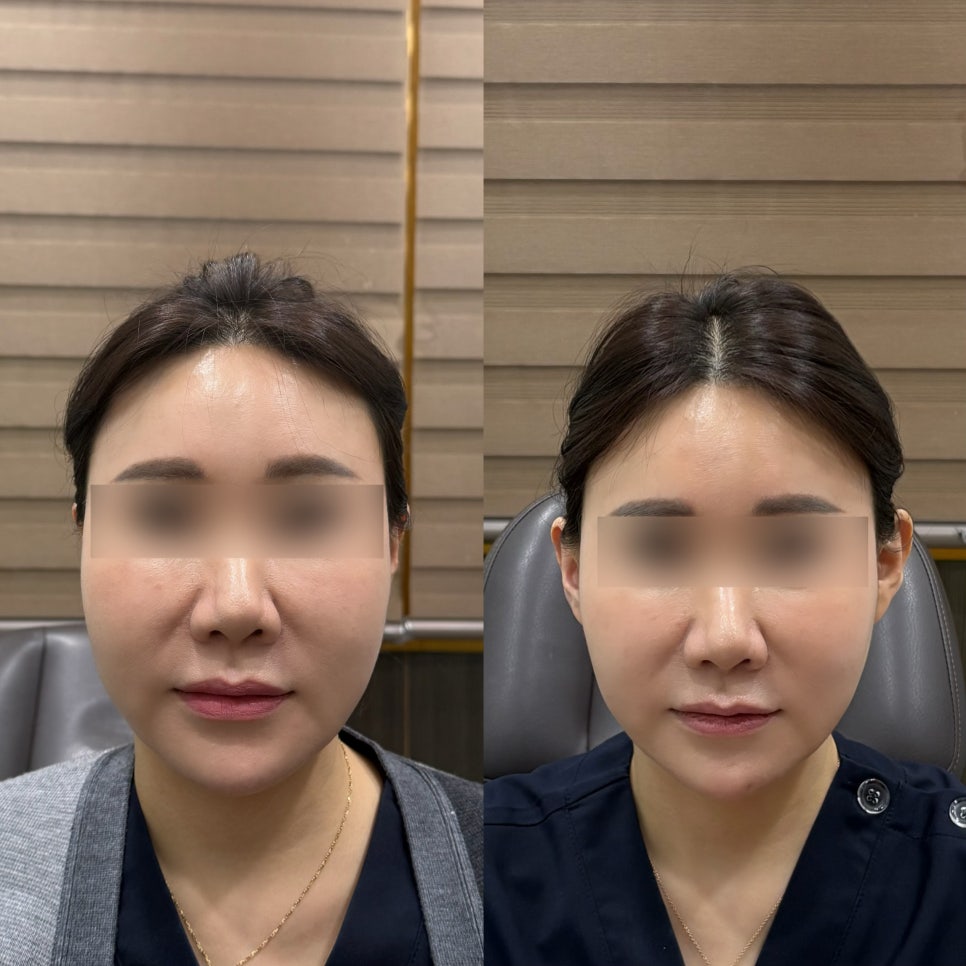 📌 납작한 귀, 귀필러로 자연스럽게 세워진 변화 관련 이미지 1