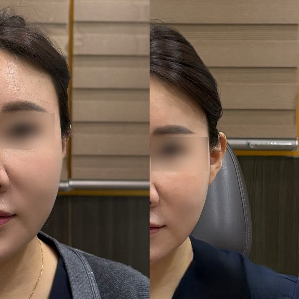 📌 납작한 귀, 귀필러로 자연스럽게 세워진 변화 관련 이미지 3