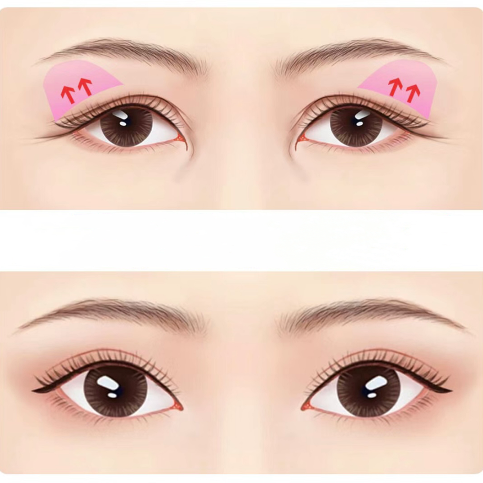 Learn About Brow Lift Surgery image 1