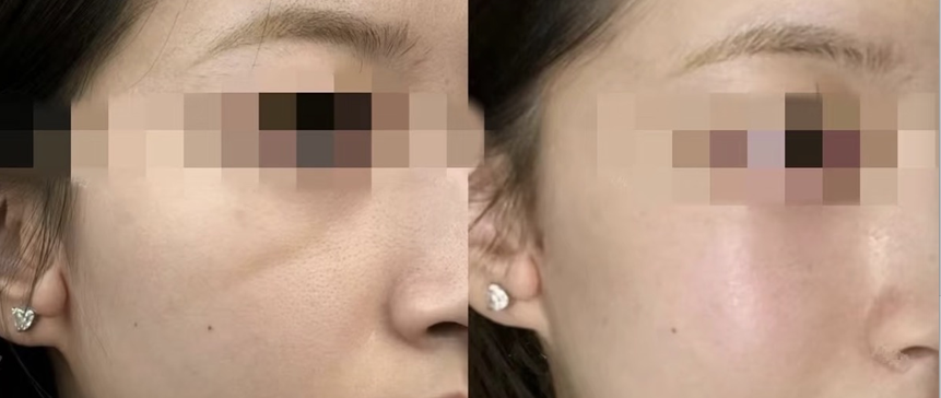 광대필러, 자연스러운 볼륨으로 어려 보이는 인상 만들기 관련 이미지 1