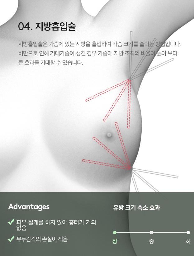 [Note Plastic Surgery] Let’s Learn About Breast Reduction! image 5