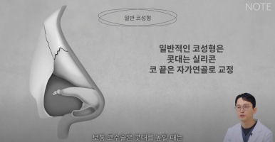 강남 코성형외과 코수술 잘하는 곳 추천 논현역 노트성형외과의 무보형물 자가연골 코성형수술로 자연스러운 코성형 관련 이미지 3
