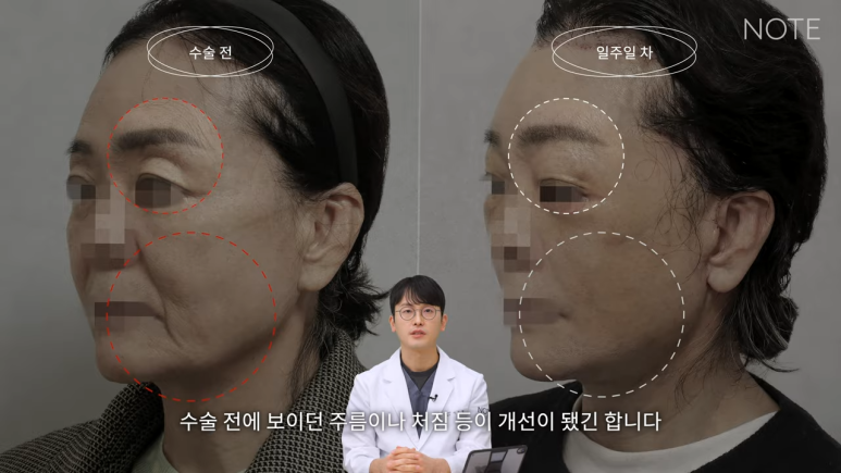 논현 리프팅 안면거상술 유명한 곳 추천 강남 노트성형외과의 안면거상 케이스 리뷰 수술 후 한 달 차 관련 이미지 2