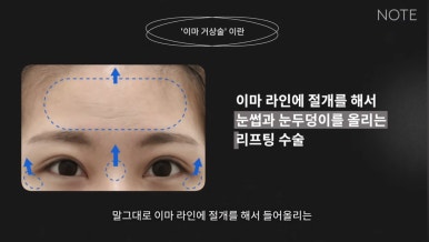 강남 성형외과 유명한 곳 논현역 리프팅 잘하는 곳 노트성형외과의 이마거상수술 쌍꺼풀수술 관련 이미지 5