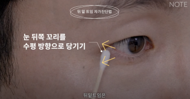 Gangnam Eye Plastic Surgery Clinic: A place that does eye corner surgery well, Nonhyeon Station Note Plastic Surgery explains—Is my eye suitable for corner surgery? Epicanthoplasty, outer canthoplasty, and lower canthoplasty image 13