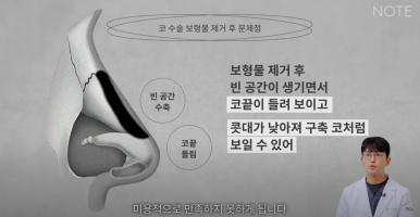 Recommended Gangnam Rhinoplasty Clinic: A Guide to Nose Surgery at Nonhyeon Note Plastic Surgery, Including Post-Rhinoplasty Inflammation and Implant Removal image 21