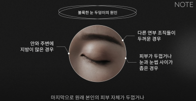 강남 눈성형외과 쌍꺼풀수술 잘하는 곳 논현역 노트성형외과의 불룩한 눈두덩이 원인과 적합한 케이스별 쌍수 방법은? 관련 이미지 13