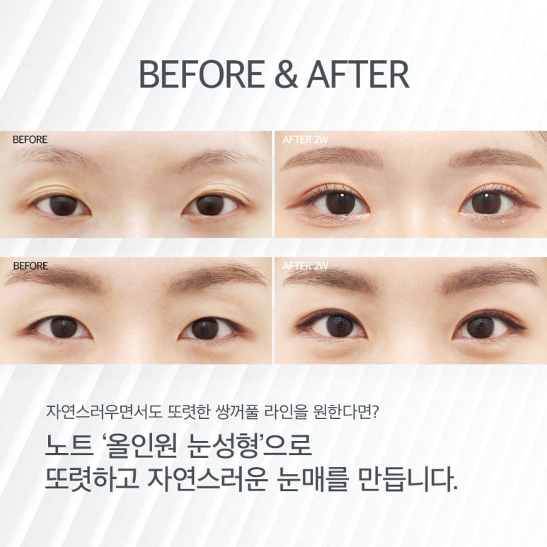 If you’re planning double eyelid surgery during winter break? One-stop eye surgery at Note Plastic Surgery, a well-known eye plastic surgery clinic near Nonhyeon Station, for double eyelid surgery and epicanthoplasty all at once! image 7