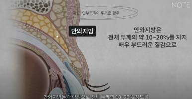 강남 눈성형외과 추천 눈수술 잘하는 곳 논현역 노트성형외과의 두꺼운 눈두덩이 눈위지방이 많다면? 관련 이미지 5