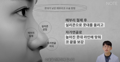 Gangnam Male Nose Surgery, Hump Nose Rhinoplasty, a Place Known for Good Natural Nose Surgery Recommendation: What Is the Hump Nose Surgery Method at Note Plastic Surgery in Nonhyeon? image 18