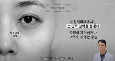 논현 눈성형외과 추천 하안검수술 눈밑지방재배치 잘하는 곳 강남 노트성형외과의 중년 눈성형 케이스 비교 분석 관련 이미지 7