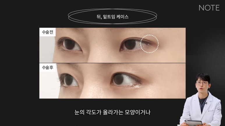 논현 트임성형 쌍꺼풀 눈수술 유명한 곳 추천 강남 노트성형외과의 트임을 하는 이유, 뒷트임, 밑트임이란? 관련 이미지 4