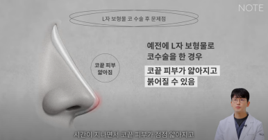 논현역 코수술 추천 코성형 잘하는 곳 강남 노트성형외과의 코수술 후 실리콘 보형물 교체를 해야하는 경우는? 관련 이미지 17