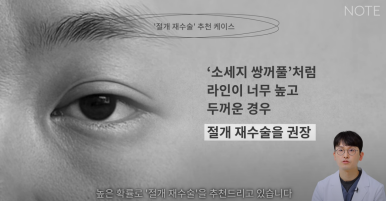 강남 쌍수재수술 눈재수술 성형외과 유명한 곳 추천 논현 노트성형외과가 말하는 매몰, 절개재수술의 모든 것 관련 이미지 10