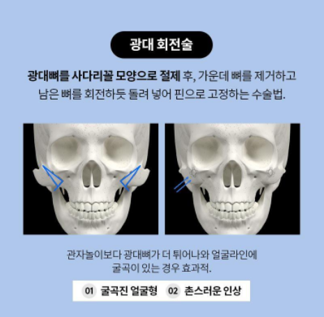 [노트성형외과] 노트 FULL 광대 축소 관련 이미지 3