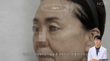 논현 안면거상 성형외과 리프팅 유명한 곳 강남 노트성형외과의 안면거상 케이스 리뷰 수술 전 고민 관련 이미지 4