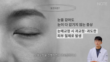 강남 눈재수술 성형외과 눈성형 잘하는 곳 논현 노트성형외과가 말하는 쌍꺼풀 부작용 토안이란? 관련 이미지 4