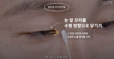 Gangnam Eye Plastic Surgery Clinic: A place that does eye corner surgery well, Nonhyeon Station Note Plastic Surgery explains—Is my eye suitable for corner surgery? Epicanthoplasty, outer canthoplasty, and lower canthoplasty image 9