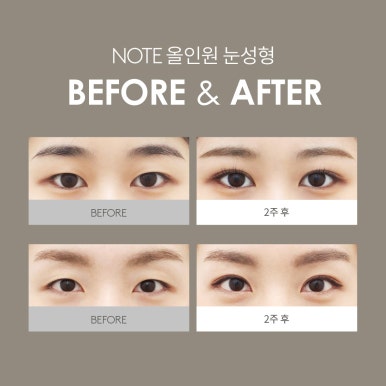 쌍꺼풀 매몰과 트임을 동시에 진행하는 노트만의 올인원 눈성형, 확실한 눈성형 효과를 원한다면? 논현 쌍꺼풀 수술 잘하는 곳, 노트성형외과의 올인원 눈성형 전후 후기 사진 확인하기! 관련 이미지 7