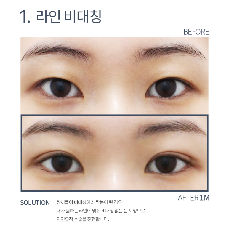 자연유착 쌍꺼풀 후기가 궁금하다면? 강남 눈성형외과 쌍수 잘하는 곳 논현역 노트성형외과의 다중매몰 자연유착으로 자연스러운 쌍수 관련 이미지 5