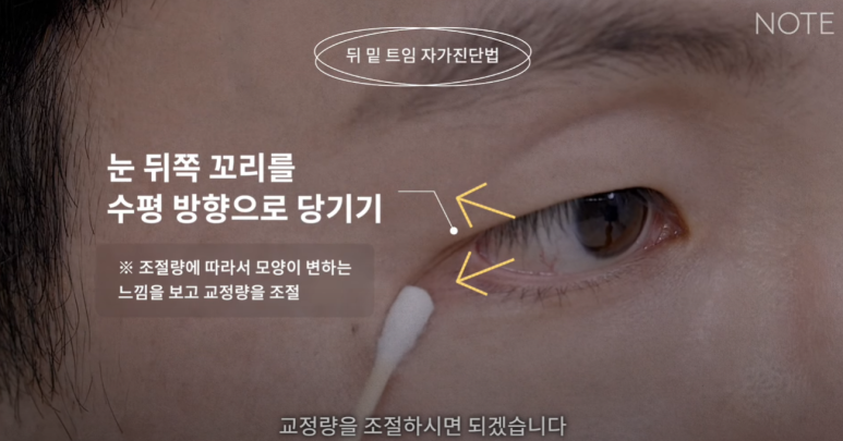 Gangnam Eye Plastic Surgery Clinic: A place that does eye corner surgery well, Nonhyeon Station Note Plastic Surgery explains—Is my eye suitable for corner surgery? Epicanthoplasty, outer canthoplasty, and lower canthoplasty image 17