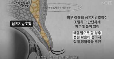 강남 눈성형외과 추천 눈수술 잘하는 곳 논현역 노트성형외과의 두꺼운 눈두덩이 눈위지방이 많다면? 관련 이미지 19