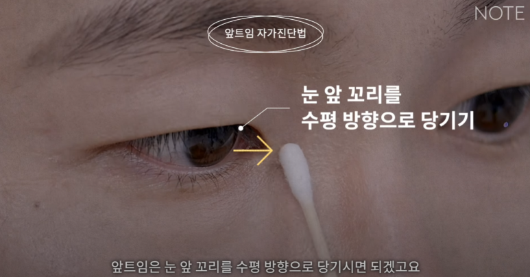 Gangnam Eye Plastic Surgery Clinic: A place that does eye corner surgery well, Nonhyeon Station Note Plastic Surgery explains—Is my eye suitable for corner surgery? Epicanthoplasty, outer canthoplasty, and lower canthoplasty image 8