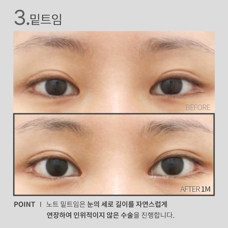 논현 눈성형 잘하는 곳 노트성형외과의 눈앞트임, 뒤트임, 밑트임, 듀얼트임까지! 트임성형 효과 확실한 눈트임수술 관련 이미지 6