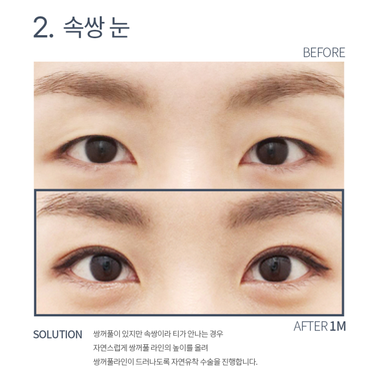 자연유착 쌍꺼풀 후기가 궁금하다면? 강남 눈성형외과 쌍수 잘하는 곳 논현역 노트성형외과의 다중매몰 자연유착으로 자연스러운 쌍수 관련 이미지 6