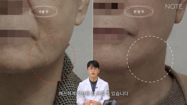 논현 리프팅 안면거상술 유명한 곳 추천 강남 노트성형외과의 안면거상 케이스 리뷰 수술 후 한 달 차 관련 이미지 10