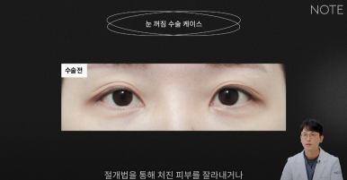 For a Seoul Eye Plastic Surgery Clinic in Gangnam, What Is the Right Procedure for Sunken Eyes? Note Plastic Surgery near Nonhyeon Station: Eyelid Correction Surgery and Fat Grafting for Sunken Eyes image 8