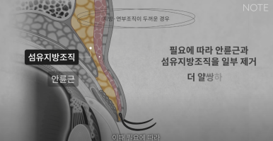 강남 눈성형외과 추천 눈수술 잘하는 곳 논현역 노트성형외과의 두꺼운 눈두덩이 눈위지방이 많다면? 관련 이미지 21