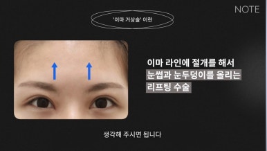 강남 성형외과 유명한 곳 논현역 리프팅 잘하는 곳 노트성형외과의 이마거상수술 쌍꺼풀수술 관련 이미지 8