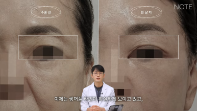 논현 리프팅 안면거상술 유명한 곳 추천 강남 노트성형외과의 안면거상 케이스 리뷰 수술 후 한 달 차 관련 이미지 7