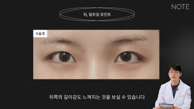 논현 트임성형 쌍꺼풀 눈수술 유명한 곳 추천 강남 노트성형외과의 트임을 하는 이유, 뒷트임, 밑트임이란? 관련 이미지 8