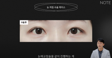 For a Seoul Eye Plastic Surgery Clinic in Gangnam, What Is the Right Procedure for Sunken Eyes? Note Plastic Surgery near Nonhyeon Station: Eyelid Correction Surgery and Fat Grafting for Sunken Eyes image 9