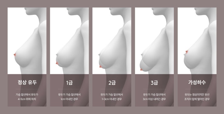 [NOTE Plastic Surgery] Sagging Breasts After Childbirth: What Are the Improvement Methods? image 2