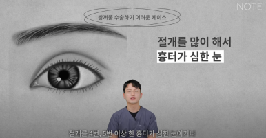 논현 눈성형외과 유명한 곳 강남역 눈성형 노트성형외과의 쌍수 어려운 케이스는? 눈재수술, 안검하수 졸린눈 관련 이미지 4