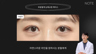 Recommended Place for Double Eyelid Surgery in Gangnam: What Is Partial-Incision Ptosis Correction at Nonhyeon NOTE Plastic Surgery? image 6