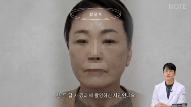 논현 리프팅 안면거상술 유명한 곳 추천 강남 노트성형외과의 안면거상 케이스 리뷰 수술 후 한 달 차 관련 이미지 5