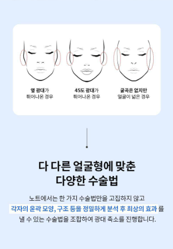 [노트성형외과] 노트 FULL 광대 축소 관련 이미지 1
