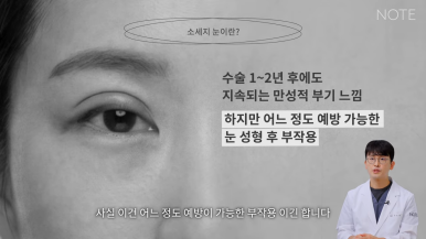 Nonhyeon Revision Eyelid Surgery Plastic Surgery, Famous for Eye Surgery in Gangnam: What Is the “Sausage Eye” Double Eyelid Surgery Side Effect, Says NOTE Plastic Surgery? image 4