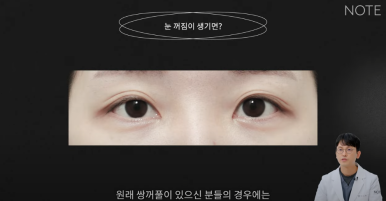 꺼진 눈이 생기는 이유는 따로 있다? 강남 눈성형 잘하는 곳 추천 노트성형외과의 눈꺼짐 해결을 위한 쌍커풀성형과 눈매교정, 지방이식수술 관련 이미지 8