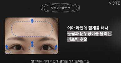 강남 성형외과 이마거상 잘하는 곳 논현역 노트성형외과의 이마거상 리프팅 전후 효과가 좋은 케이스는? 관련 이미지 5