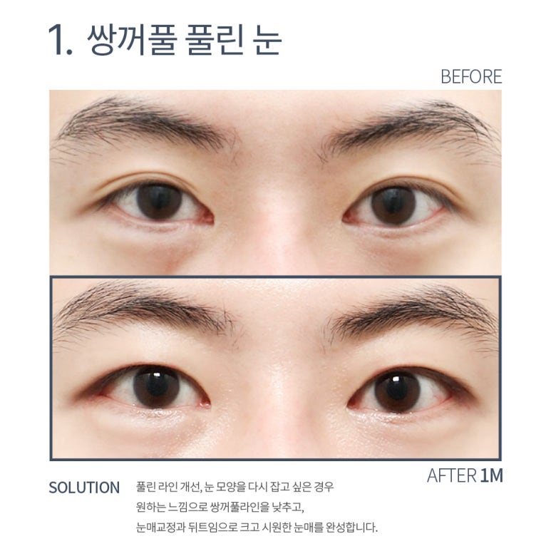 강남 쌍꺼풀재수술 잘하는 곳 논현역 노트성형외과의 소시지 쌍수 눈재수술 후기 관련 이미지 7