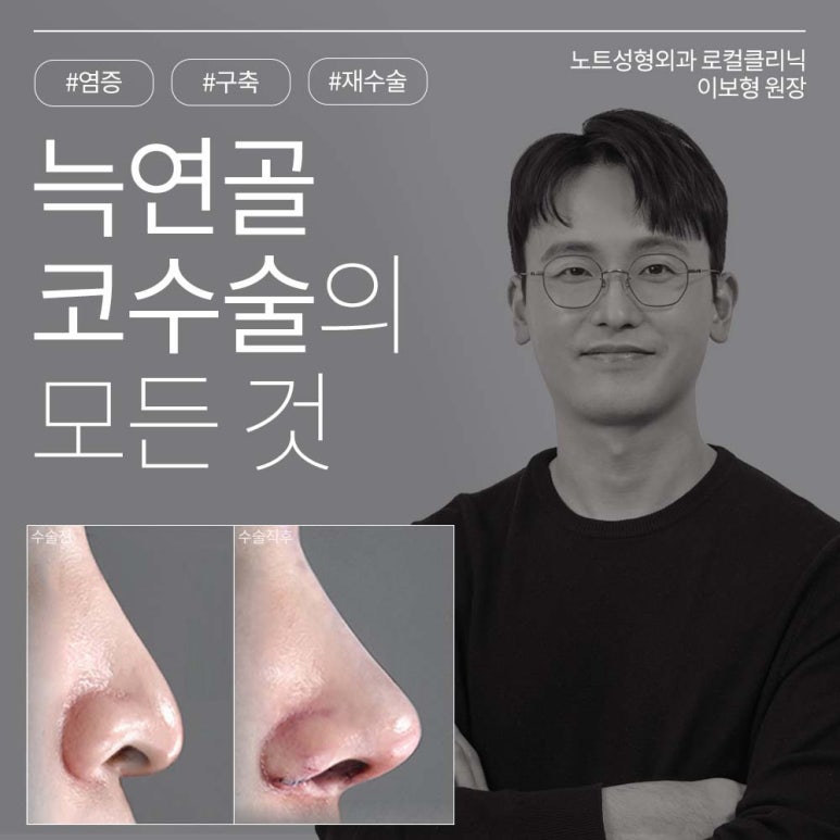 Well-known Gangnam Plastic Surgery Clinic Recommended for Nose Surgery: What Are the Differences Between Donated Rib Cartilage and Autologous Rib Cartilage Rhinoplasty, as Explained by Note Plastic Surgery at Nonhyeon Station? image 1